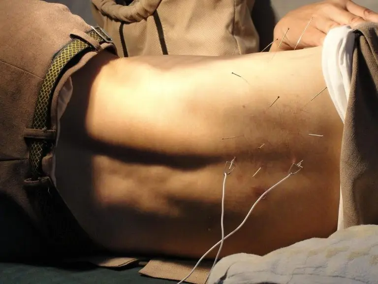Acupuncturist in Barneveld voert natuurlijke behandeling uit met dunne naaldjes voor pijnverlichting